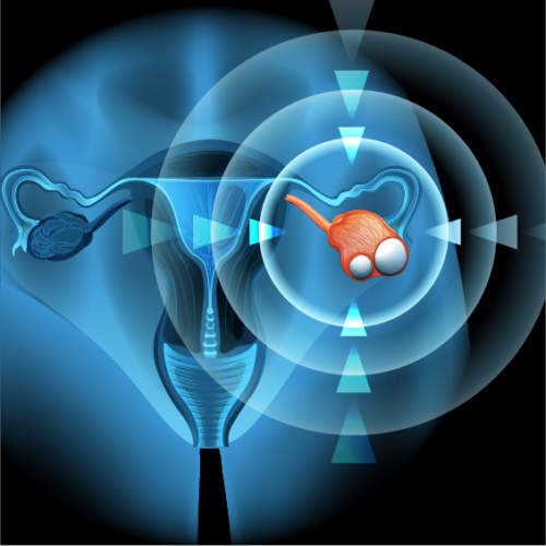 An illustration of the female reproductive system with a target on the right ovary. There are growths on the ovary indicating cancer.