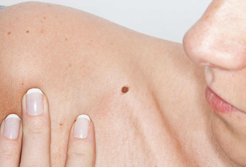 Macro shot of a big skin mole on a woman's shoulder that should be inspected by a dermatologist.