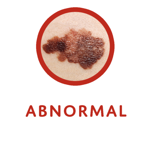 How to Check Your Moles for Skin Cancer - Prevent Cancer Foundation
