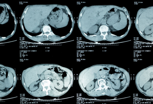 Image of a lung cat scan film.