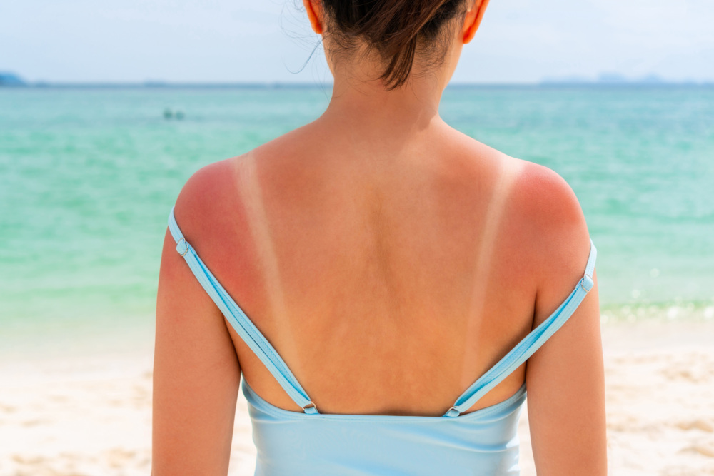 Sunburned skin on shoulder and back of a woman because of not using sunscreen.